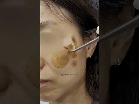 피부 흑자 치료, 리팟 레이저 효과와 의학적 관리법