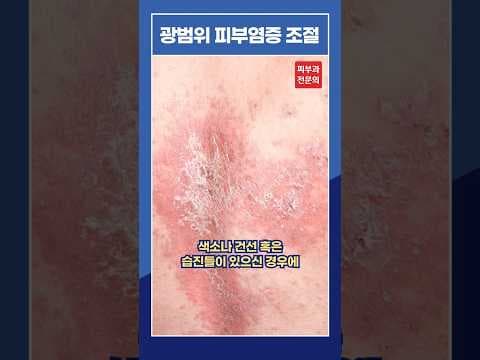 전신 피부질환 광선 치료: 벨로시티7 & 필립스, 의학 정보