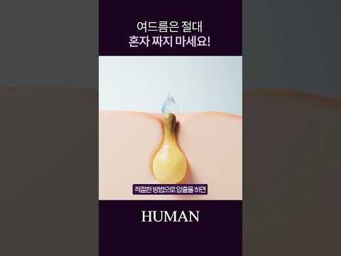 여드름 압출, 피부 의학적으로 올바르게 관리하는 방법
