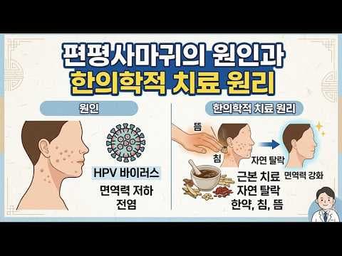 편평사마귀 면역 의학 율무 한방 맞춤 치료! 활동성 사마귀 잡는 법